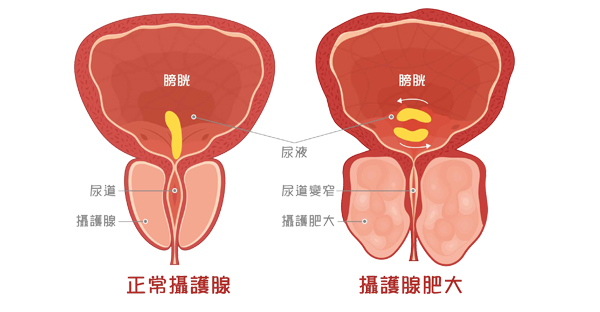 前列腺增生 (攝護腺腫大)